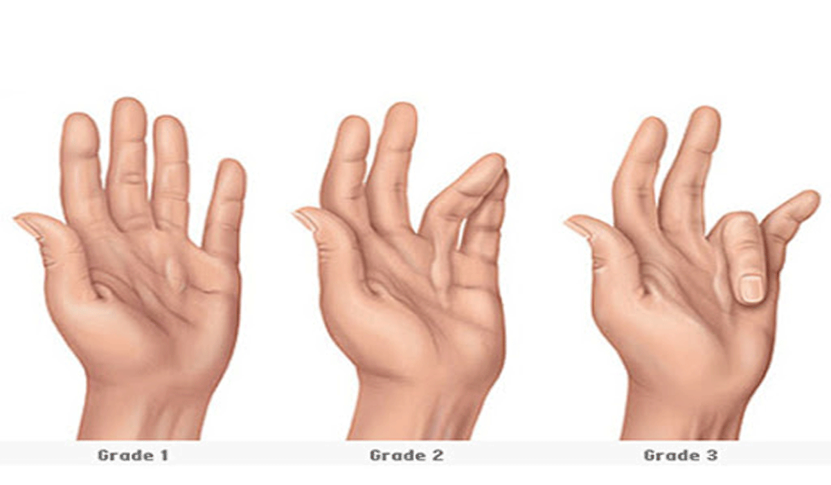 Finger Health Matters: Preventing & Managing Common Finger Disorders